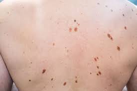 Mole Removal for Women: Safe Options